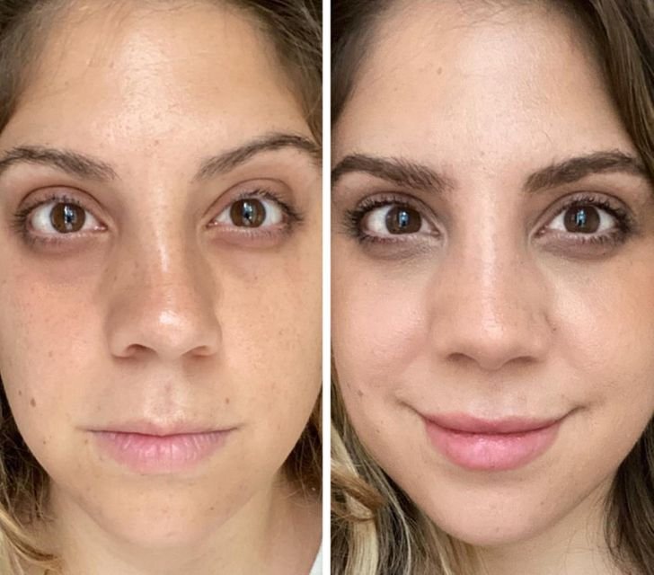 Ринопластика 2023. Септоринопластика. Септоринопластика до и после. Операция септоринопластика. После септоринопластика операции.