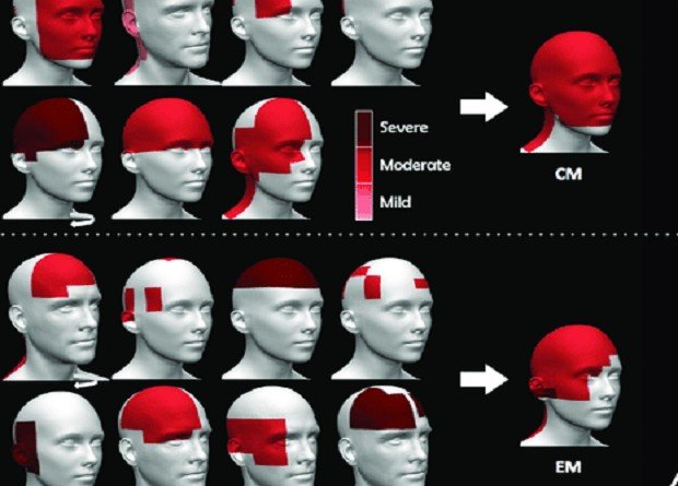 Генетики раскрыли тайну хронической мигрени: новые открытия и исследования